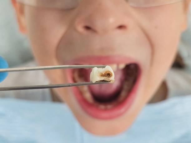Best Emergency Treatment for Toothache in Elleale, ND